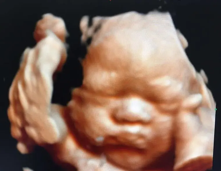 Imbasan 5D wajah bayi di U.n.i Klinik IM2